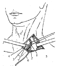 Анатомические взаимоотношения в ране при наружном дренировании грудного лимфатического протока
